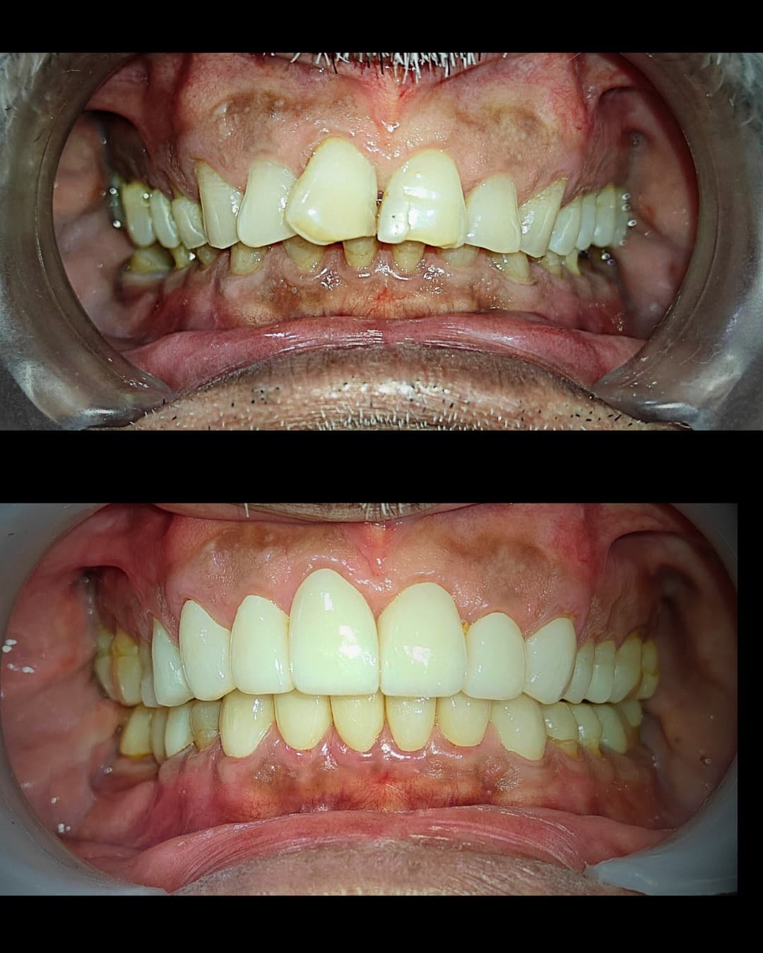 Full Mouth Rehabilitation
