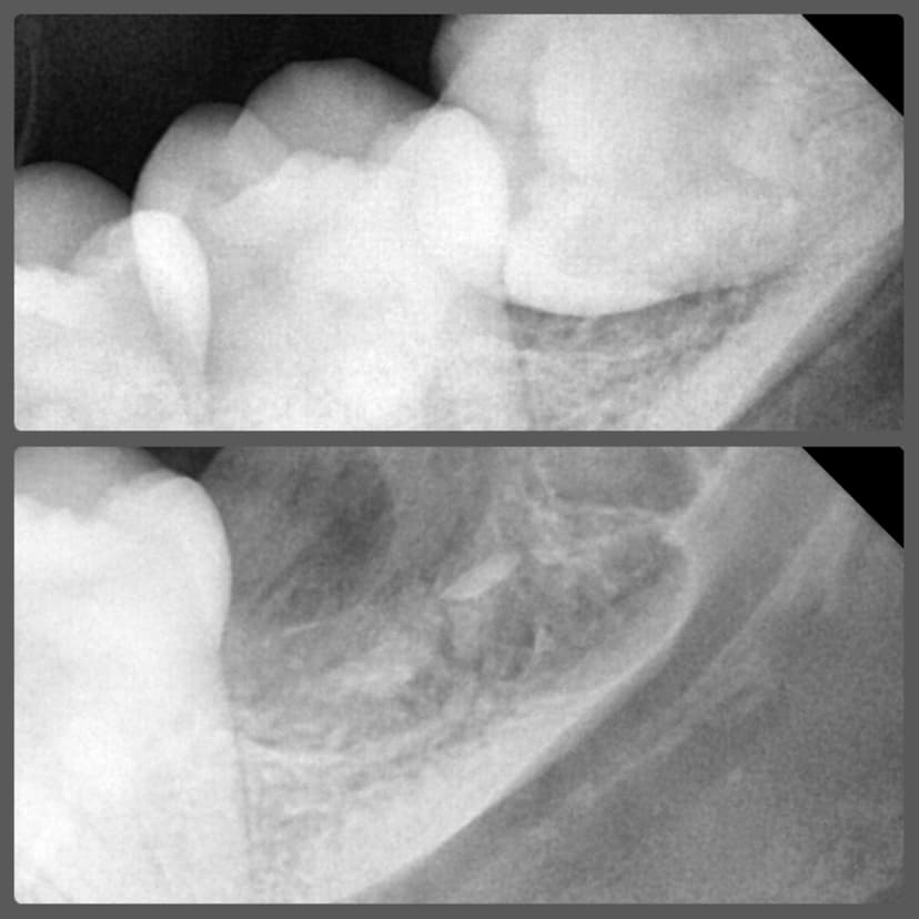 Wisdom Tooth Removal